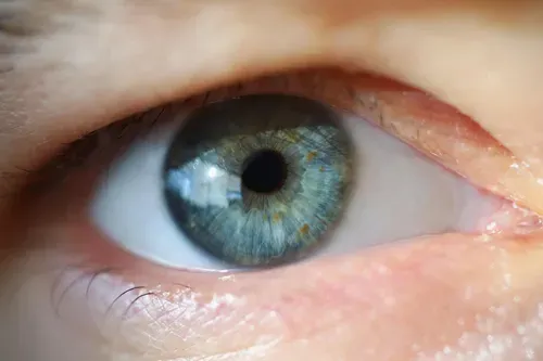 aging eye