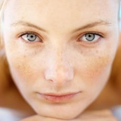 melasma