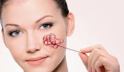 rosacea