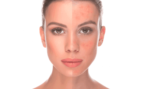 rosacea