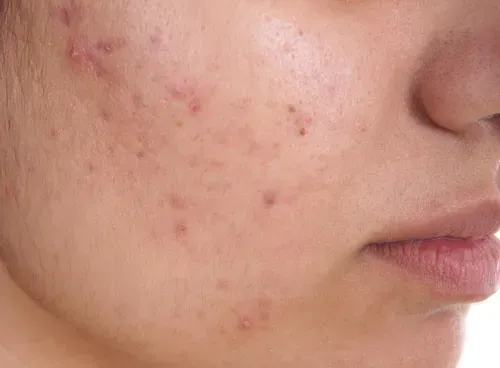 skin blemishes