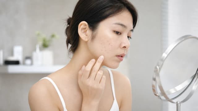 Editorial image for A Complete Guide to Acne Scar Types and Treatments