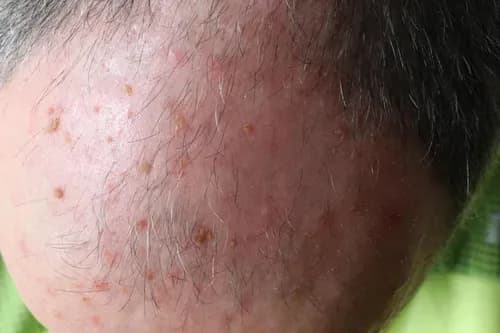 actinic keratosis