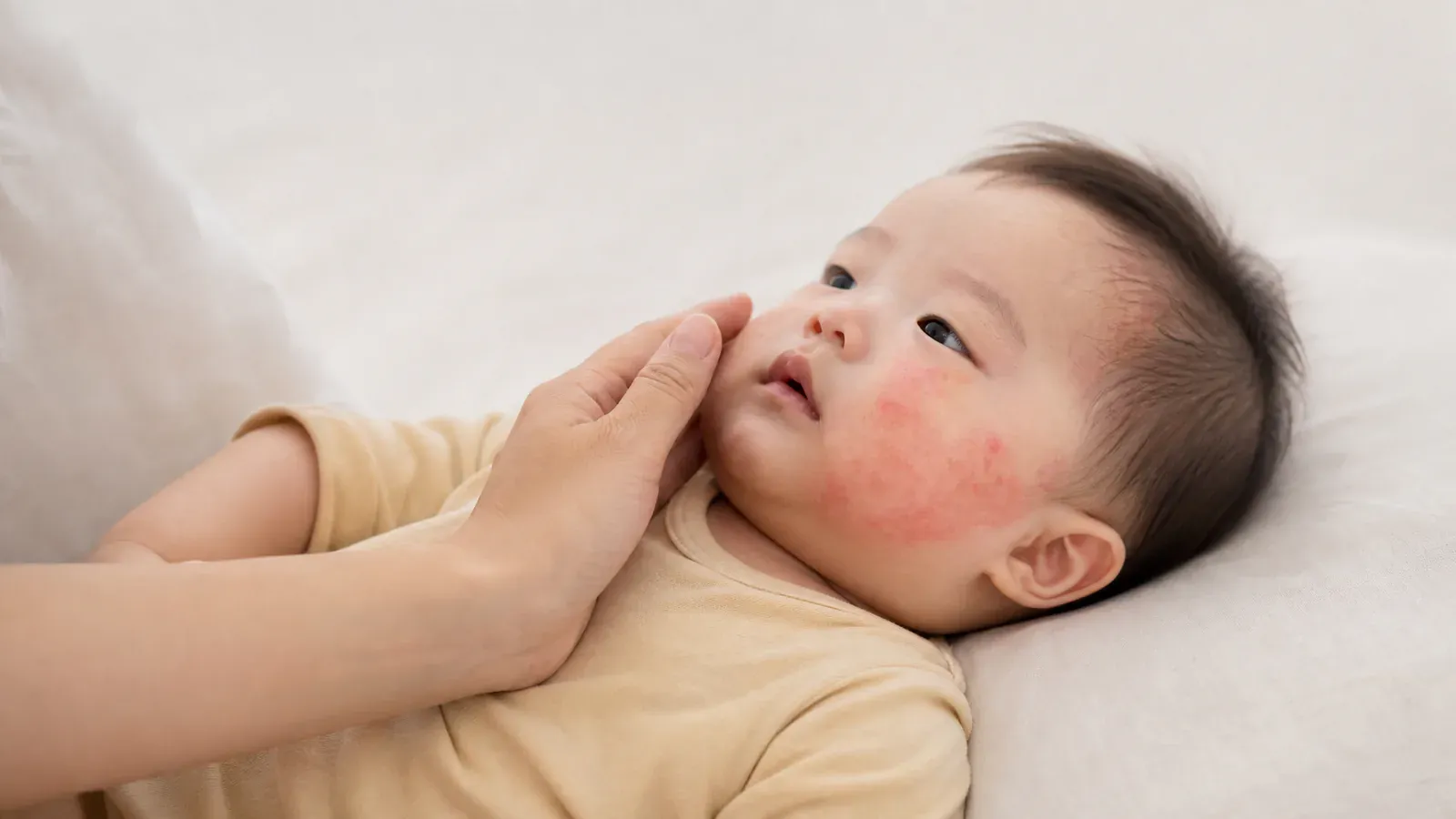 「異位性皮膚炎:了解好發部位與正確識別」的專題圖片