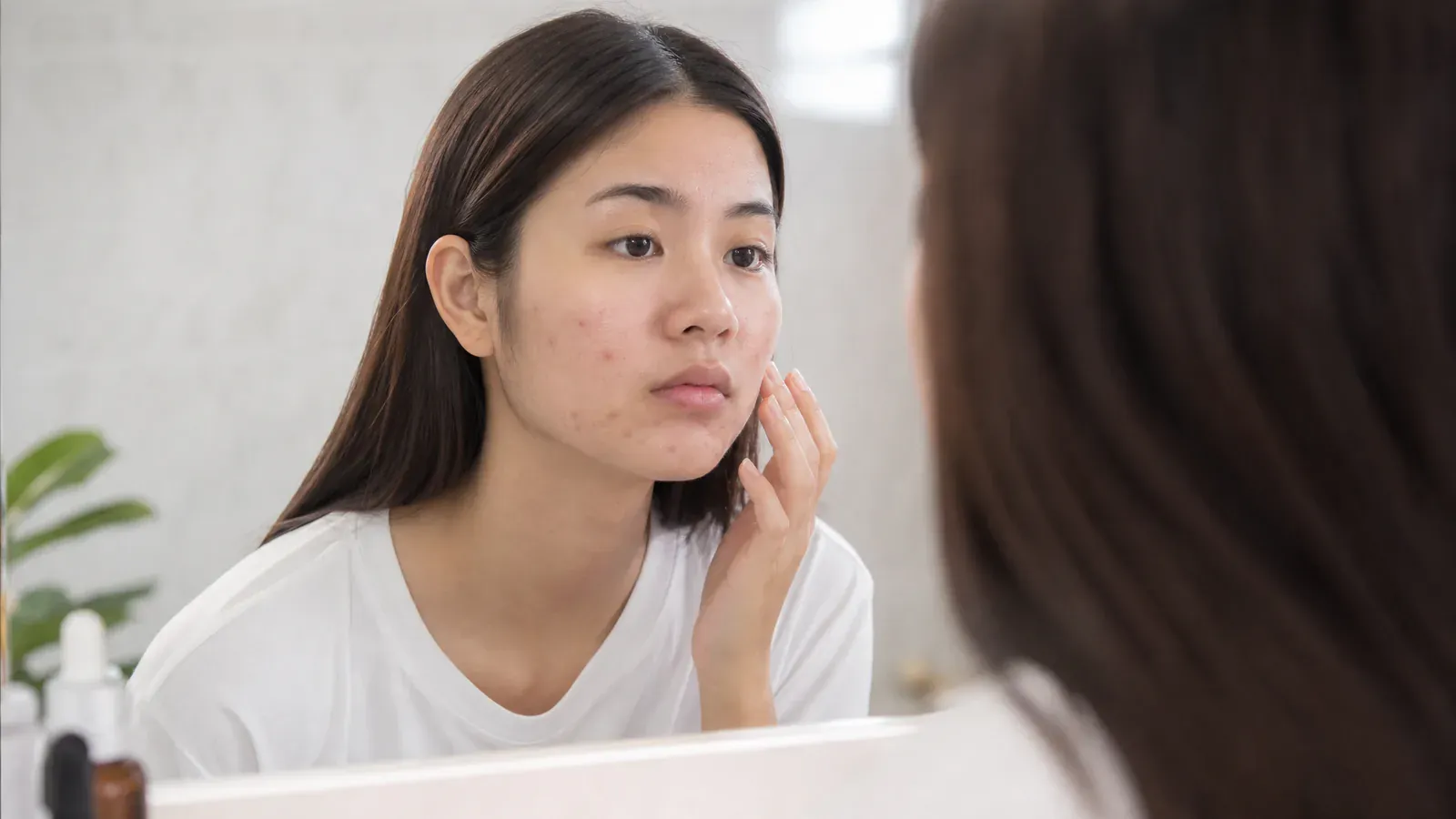 「大學生皮膚問題解決指南:暗瘡與暗瘡疤痕的對策」的專題圖片