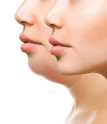 double chin treatment