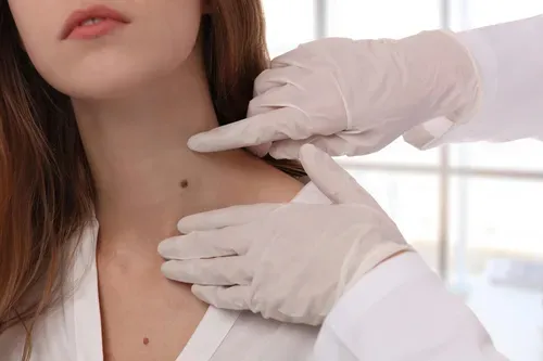 Nevus