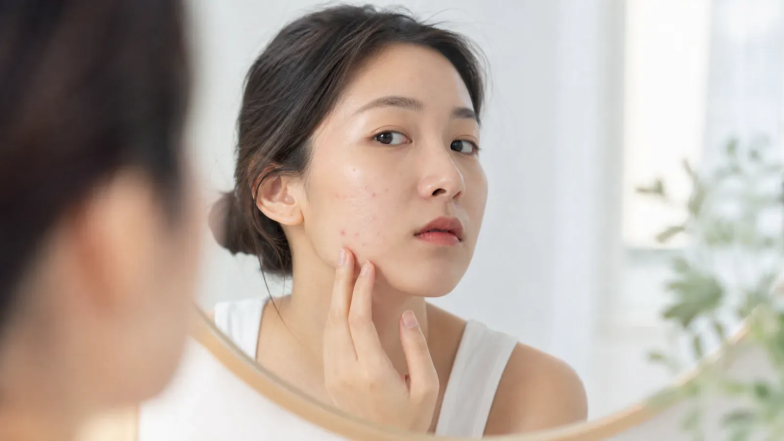 「新一代抗痘利器:第四代A酸Aklief」的專題圖片