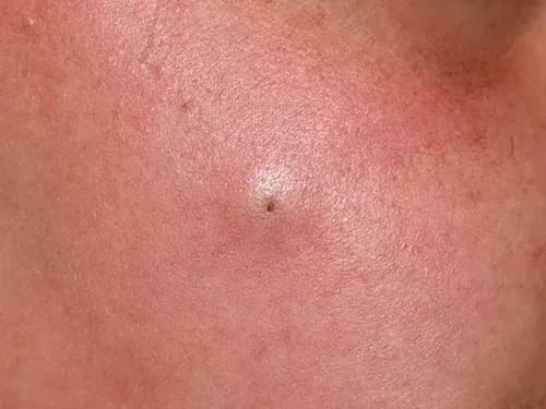 sebaceous cyst
