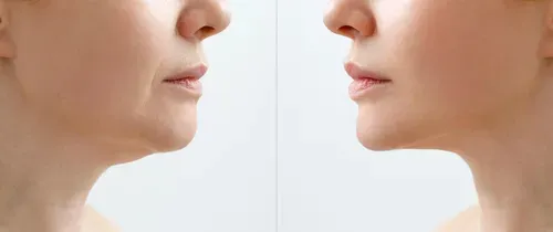 short chin