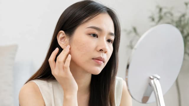 Editorial image for The Real Considerations for Treating Acne Scars: Four Situations You Need to Be Aware Of