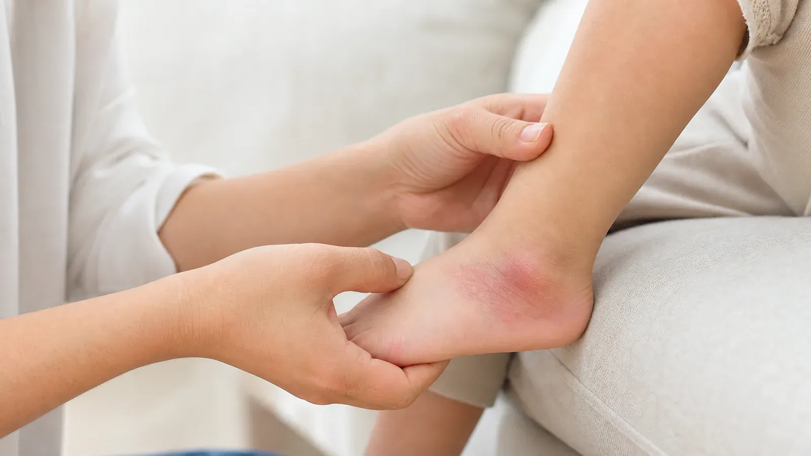 Editorial image for The Story of a Household Angel’s Burn- The Truth about Blisters, Scar Hypertrophy, and Scar Removal Cream