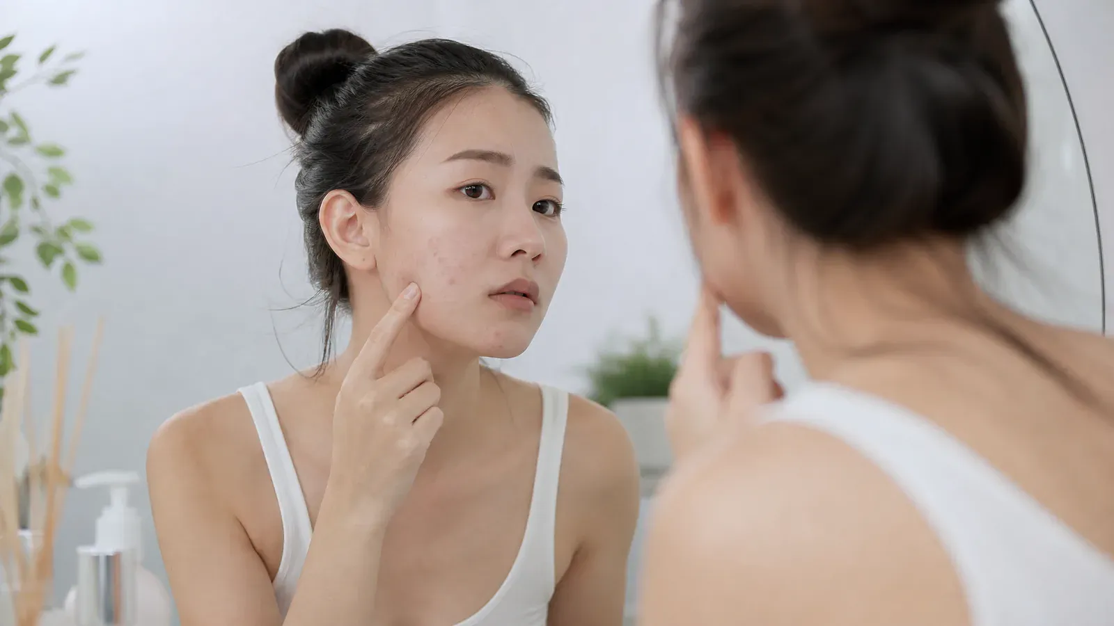 「暗瘡的真相:如何有效治療與避免疤痕?」的專題圖片